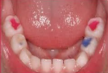Детская стоматология в СПб - цветные пломбы на зубах
