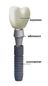 Недорогой имплантат зуба в Санкт-Петербурге