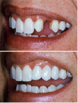 Имплантация зубов, до и после
